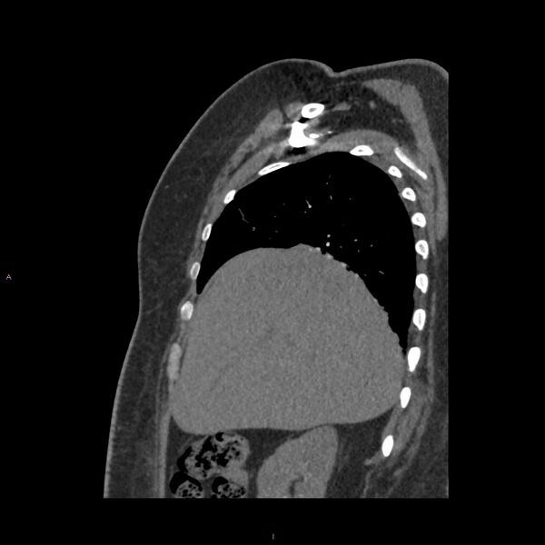 File:Agenesis of the left hepatic lobe (Radiopaedia 77284-89359 Sagittal C+ CTPA 25).jpg