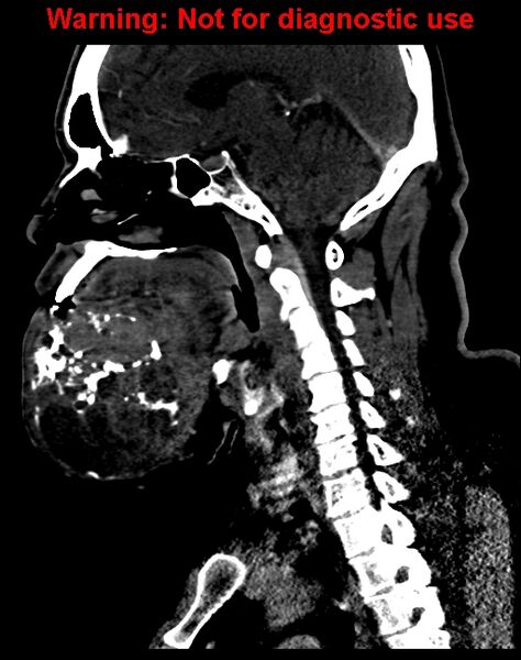 File:Ameloblastoma (Radiopaedia 33126-34164 F 35).jpg