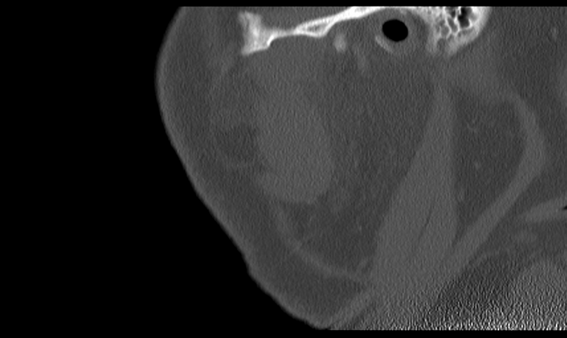 File:Ameloblastoma (Radiopaedia 33677-34806 Sagittal bone window 54).png