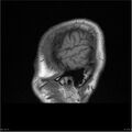 Amnestic syndrome secondary to hypoxic brain injury (Radiopaedia 24743-25004 T1 19).jpg