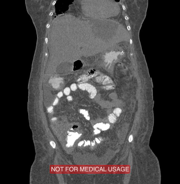 File:Amoebic enterocolitis with liver abscess (Radiopaedia 35100-36609 B 48).jpg
