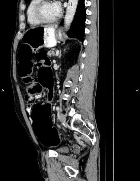 File:Ampullary adenocarcinoma (Radiopaedia 86093-102032 D 61).jpg