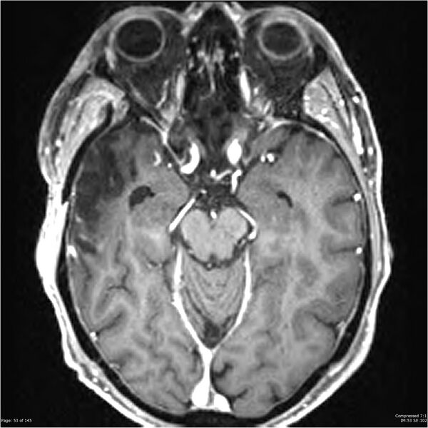 File:Anaplastic meningioma with recurrence (Radiopaedia 34452-35788 Axial T1 C+ 53).jpg