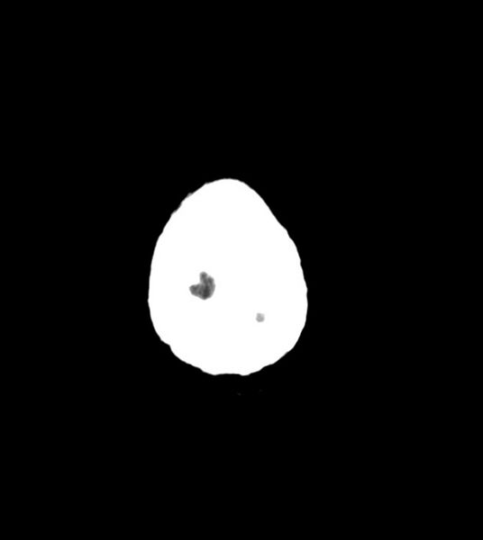 File:Anaplastic oligodendroglioma (Radiopaedia 79571-92758 Axial non-contrast 48).jpg