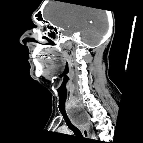 File:Anaplastic thyroid carcinoma (Radiopaedia 79087-92034 C 56).jpg