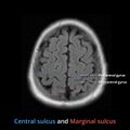 Anatomy- sulci of the brain (Radiopaedia 33834-34995 Central sulcus 11).jpg
