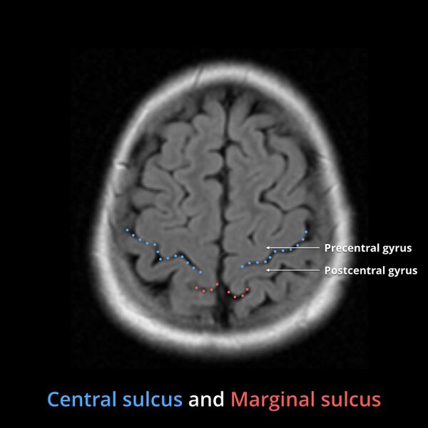 File:Anatomy- sulci of the brain (Radiopaedia 33834-34995 Central sulcus 11).jpg