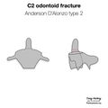 Anderson and D'Alonzo classification of C2 odontoid fractures (diagrams) (Radiopaedia 87249-103528 type 2 1).jpeg
