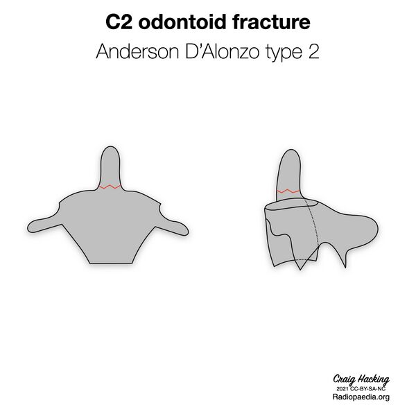 File:Anderson and D'Alonzo classification of C2 odontoid fractures (diagrams) (Radiopaedia 87249-103528 type 2 1).jpeg