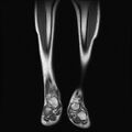 Aneurysmal bone cyst - tibia (Radiopaedia 22343-22367 Coronal T1 5).jpg