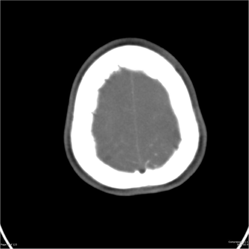 Aneurysmal subarachnoid hemorrhage and Moya Moya disease (Radiopaedia 34306-35593 Axial CT COW 8).jpg