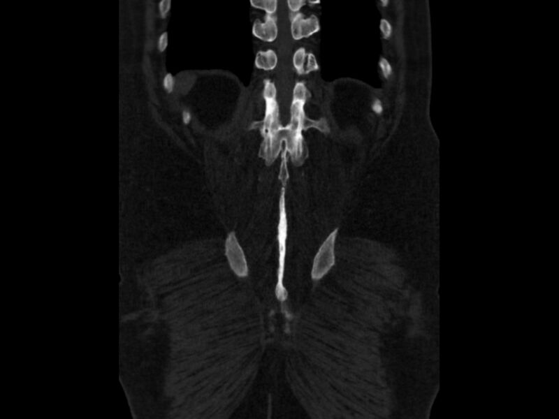 File:Ankylosing spondylitis (Radiopaedia 44609-48357 Coronal bone window 90).jpg