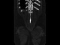 Ankylosing spondylitis (Radiopaedia 44609-48357 Coronal bone window 98).jpg