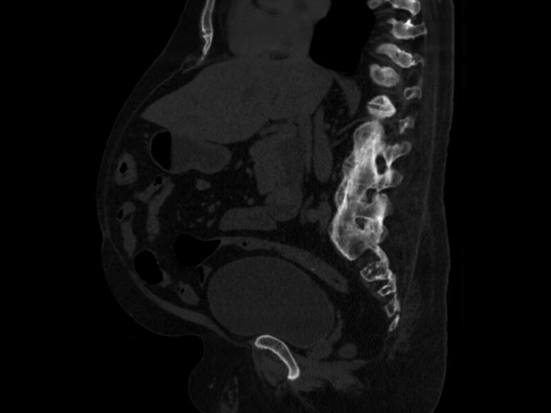 File:Ankylosing spondylitis (Radiopaedia 44609-48357 Sagittal bone window 47).jpg