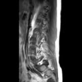 Ankylosing spondylitis with zygapophyseal arthritis (Radiopaedia 38433-40516 Sagittal T1 10).jpg