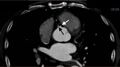 Anomalous left coronary artery- prepulmonic course (Radiopaedia 29253-29667 A 9).JPG