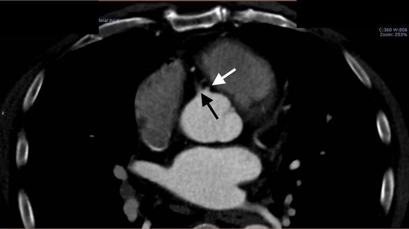 File:Anomalous left coronary artery- prepulmonic course (Radiopaedia 29253-29667 A 9).JPG