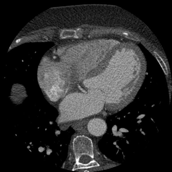 File:Anomalous origin of left circumflex artery from right coronary sinus (Radiopaedia 72563-83117 B 90).jpg