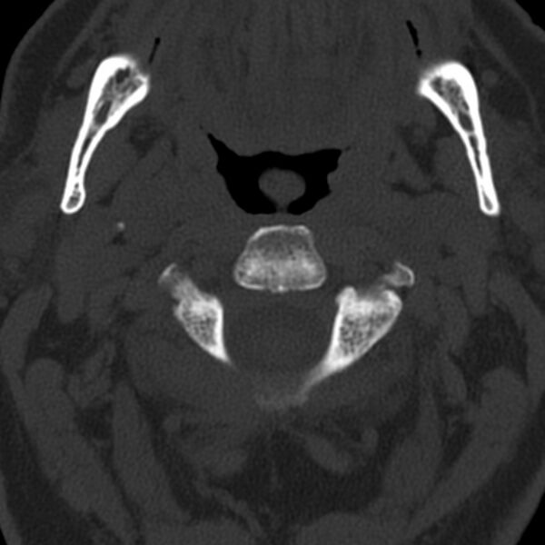File:Anterior cervical postdiscectomy arthrodesis (Radiopaedia 32678-33646 Axial bone window 21).jpg