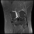 Anterior cruciate ligament tear, Wrisberg rip and bucket-handle tear of medial meniscus (Radiopaedia 75872-87266 Coronal PD fat sat 19).jpg