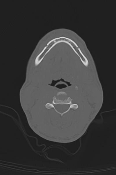 File:Anterior nasal spine fracture (Radiopaedia 46138-50494 Axial bone window 74).png