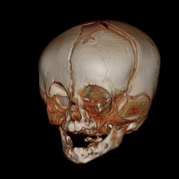 File:Anterior plagiocephaly (Radiopaedia 71836-82273 E 2).jpg