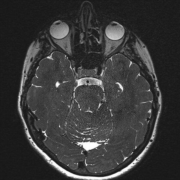 File:Anterior temporal encephalocele (Radiopaedia 82624-96808 Axial T2 high res 69).jpg
