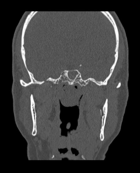 File:Antrochoanal polyp (Radiopaedia 79011-92169 Coronal bone window 13).jpg