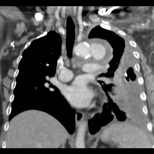 File:Aortic arch false aneurysm (Radiopaedia 14667-14588 B 8).jpg