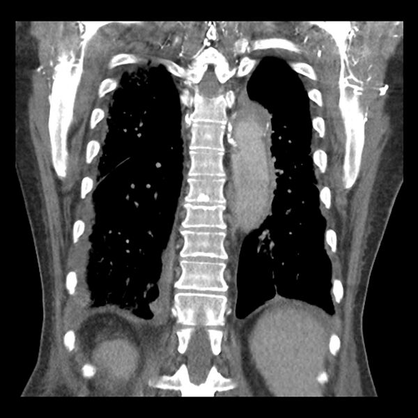 File:Aortic arch graft infection (FDG PET-CT) (Radiopaedia 71975-82437 Coronal 47).jpg