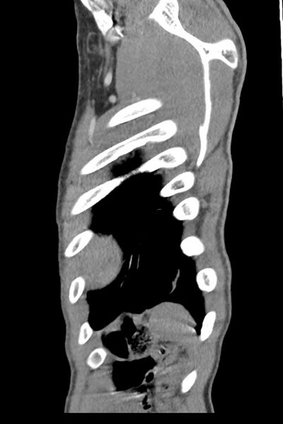 File:Aortic coarctation with aneurysm (Radiopaedia 74818-85828 B 143).jpg