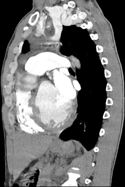 File:Aortic coarctation with aneurysm (Radiopaedia 74818-85828 B 98).jpg