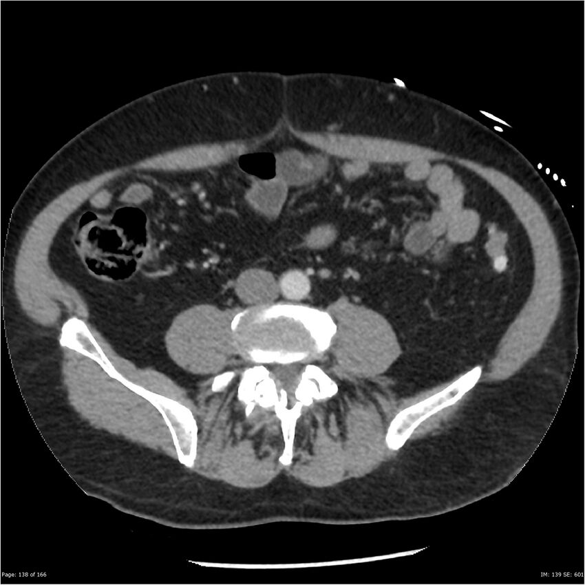 Aortic dissection- Stanford A (Radiopaedia 37759-39664 A 129).jpg