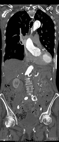 File:Aortic dissection with extension into aortic arch branches (Radiopaedia 64402-73204 A 35).jpg