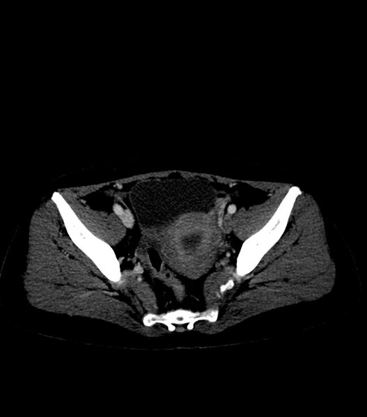 File:Aortic dissection with renal ischemia (Radiopaedia 76573-88338 B 55).jpg