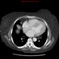 Aortic valve stenosis (Radiopaedia 14480-14423 C 13).jpg