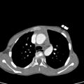 Aortopulmonary window, interrupted aortic arch and large PDA giving the descending aorta (Radiopaedia 35573-37074 B 27).jpg