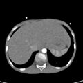 Aortopulmonary window, interrupted aortic arch and large PDA giving the descending aorta (Radiopaedia 35573-37074 B 86).jpg