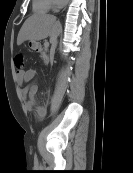 File:Appendicitis and giant appendicolith (Radiopaedia 80251-93588 C 14).jpg