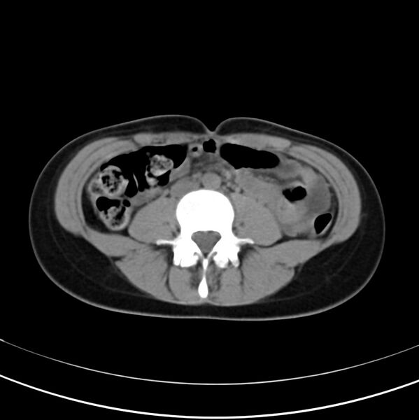 File:Appendicitis and incidental bicornuate uterus (Radiopaedia 22833-22853 Axial non-contrast 25).jpg