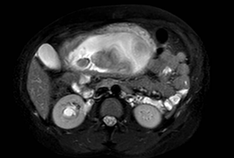 File:Appendicitis in gravida (MRI) (Radiopaedia 89433-106395 Axial T2 SPAIR 32).jpg