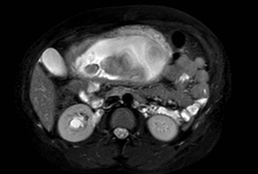 Appendicitis in gravida (MRI) (Radiopaedia 89433-106395 Axial T2 SPAIR 32).jpg