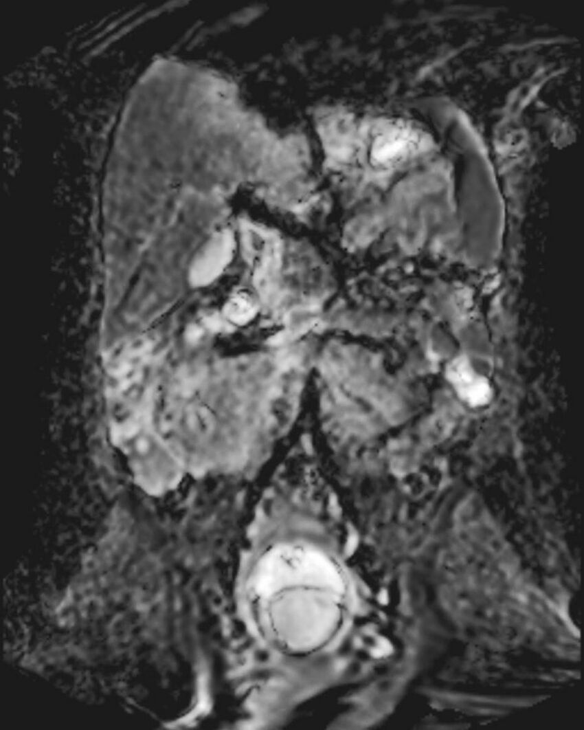 Appendicitis in gravida (MRI) (Radiopaedia 89433-106395 Coronal ADC 30).jpg