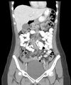 Appendicitis with minimal stranding but appendicolith (Radiopaedia 29035-29397 B 15).jpg