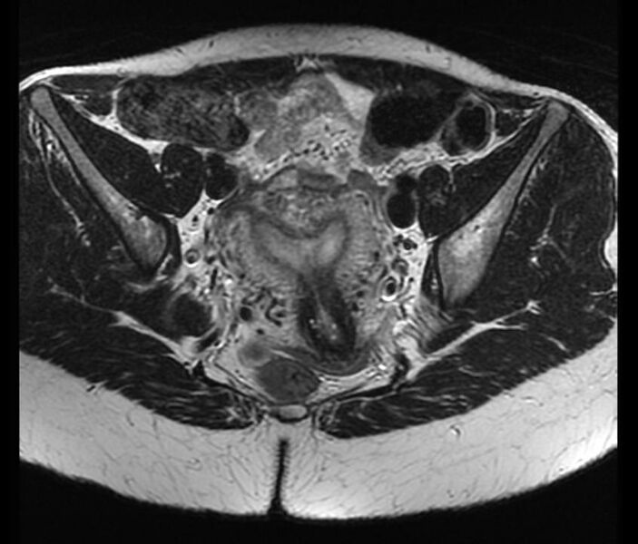 File:Arcuate uterus (Radiopaedia 11207-11571 None 1).jpg