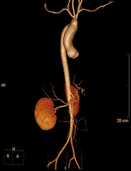 File:Ascending aortic pseudoaneurysm (Radiopaedia 28638-28910 D 3).jpg