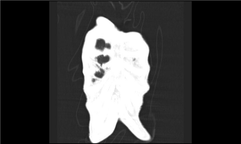 File:Aspergilloma (Radiopaedia 20788-20701 Coronal lung window 2).jpg