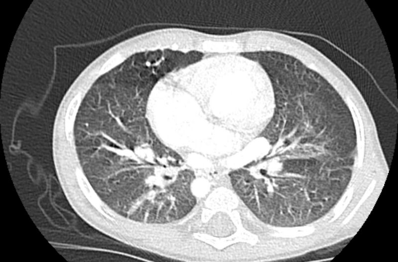 File:Asplenia syndrome (Radiopaedia 73083-83792 Axial lung window 38).jpg