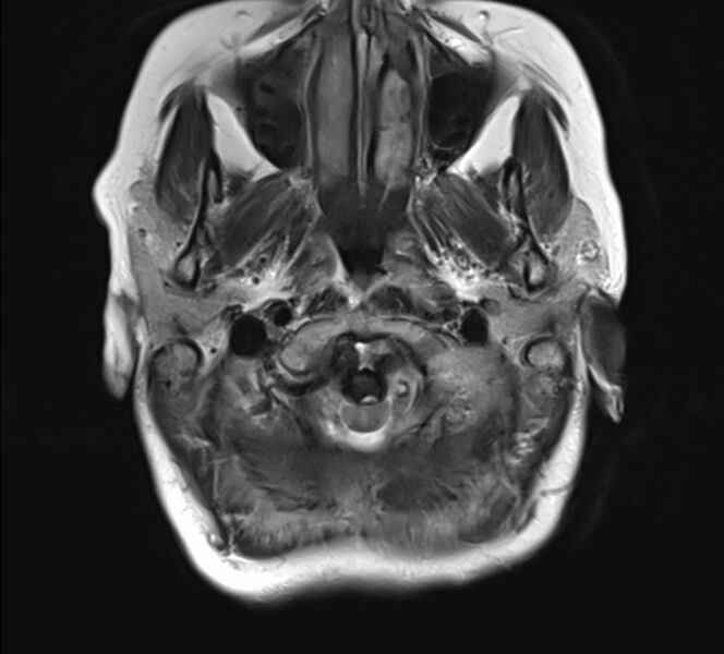 File:Atlanto-occipital assimilation with basilar invagination (Radiopaedia 70122-80157 Axial T2 2).jpg