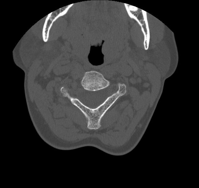 File:Atlanto-occipital assimilation with basilar invagination (Radiopaedia 70122-80188 Axial bone window 47).jpg